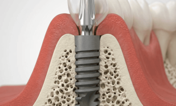 Kolik stojí zubní implantát v Praze v roce 2026?